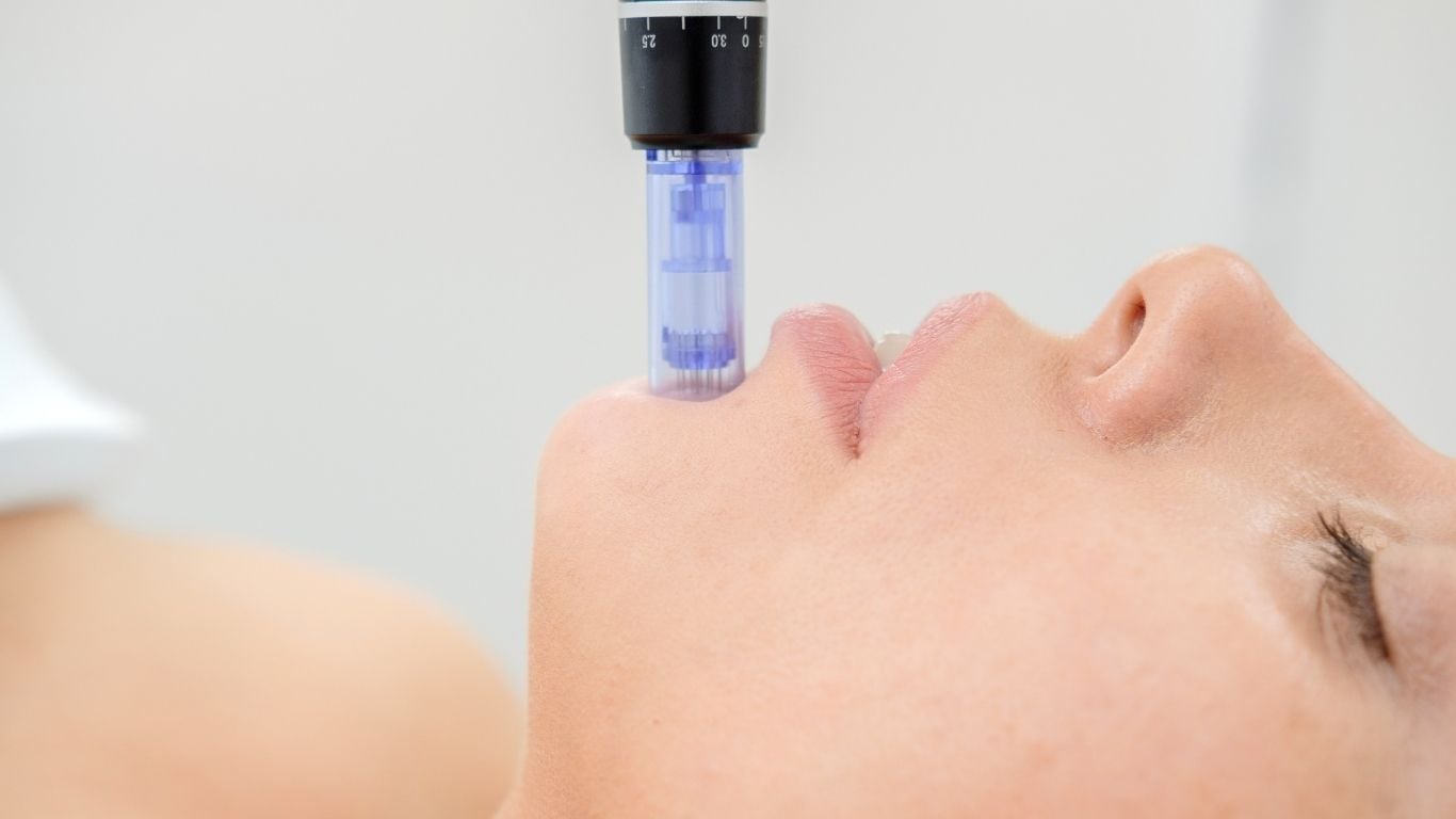 Microneedling for Acne Scars: How It Works and What Results Can You Expect? Microneedling for Acne Scars: How It Works and What Results Can You Expect?